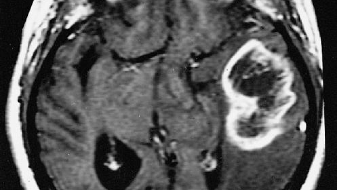 MRI image of a glioblastoma multiforme. (Source: Wikimedia/The Armed Forces Institute of Pathology)