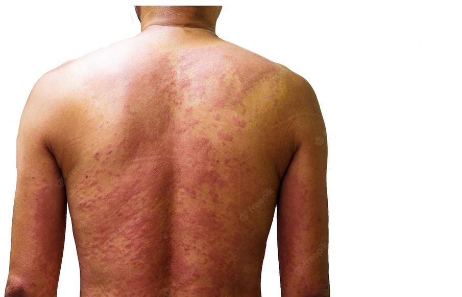 Allergic Drug Reaction Man Back Sweling with Rashes due to Drug