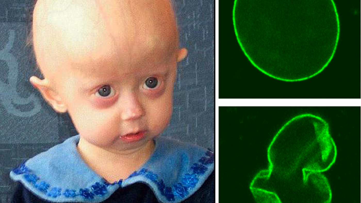 bt1505_cynthia_Hutchinson-Gilford_Progeria_Syndrome