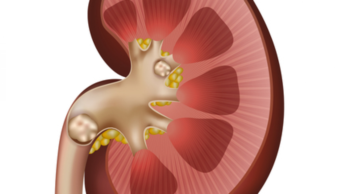 shutterstock_kidney_stones_1
