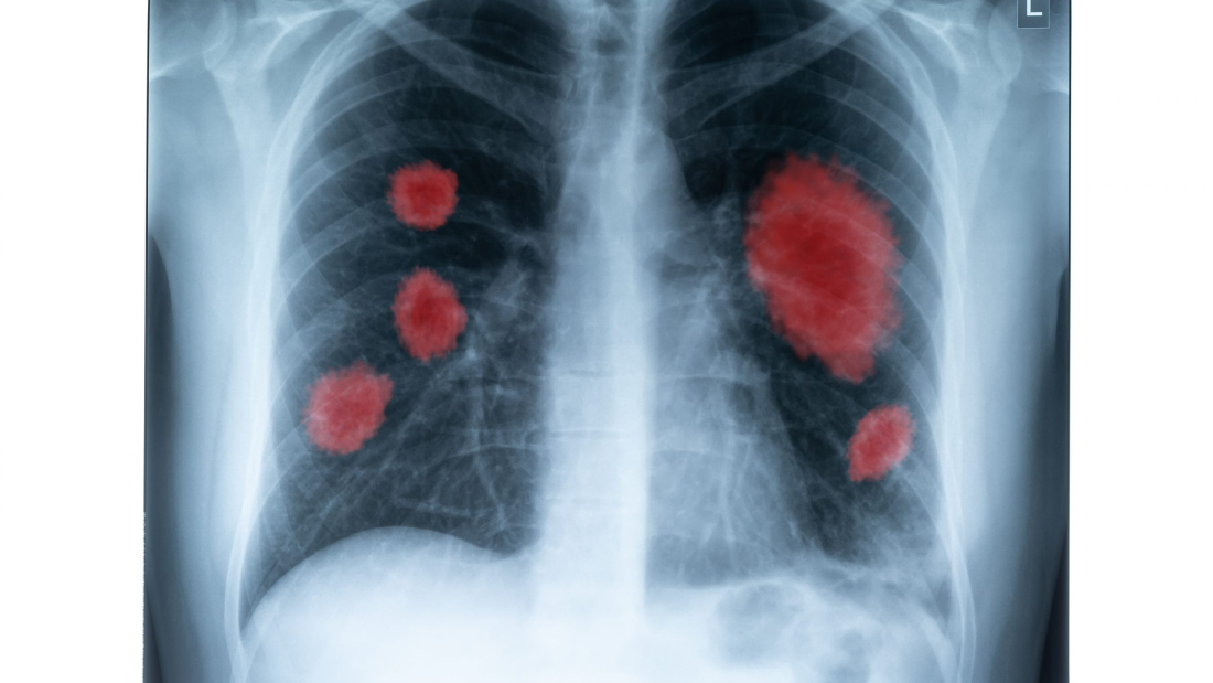 X-Ray image of human chest for a medical diagnostic. Coronavirus-COVID-19. Epidemic virus 2019-nCoV Respiratory Syndrome. Medicine concept.
