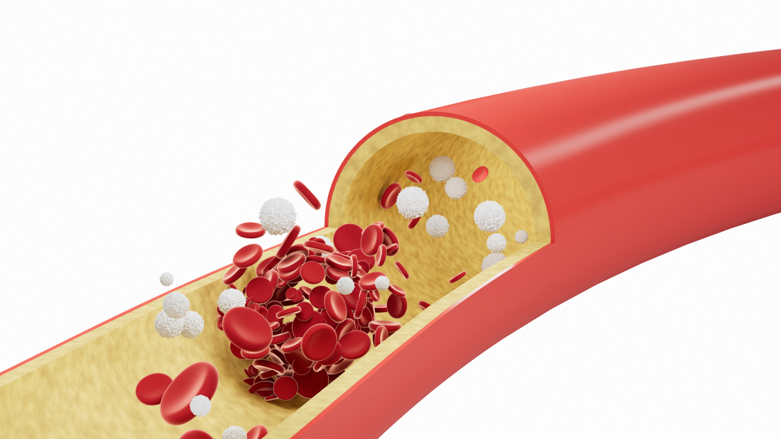 Vasculitis treatment market
