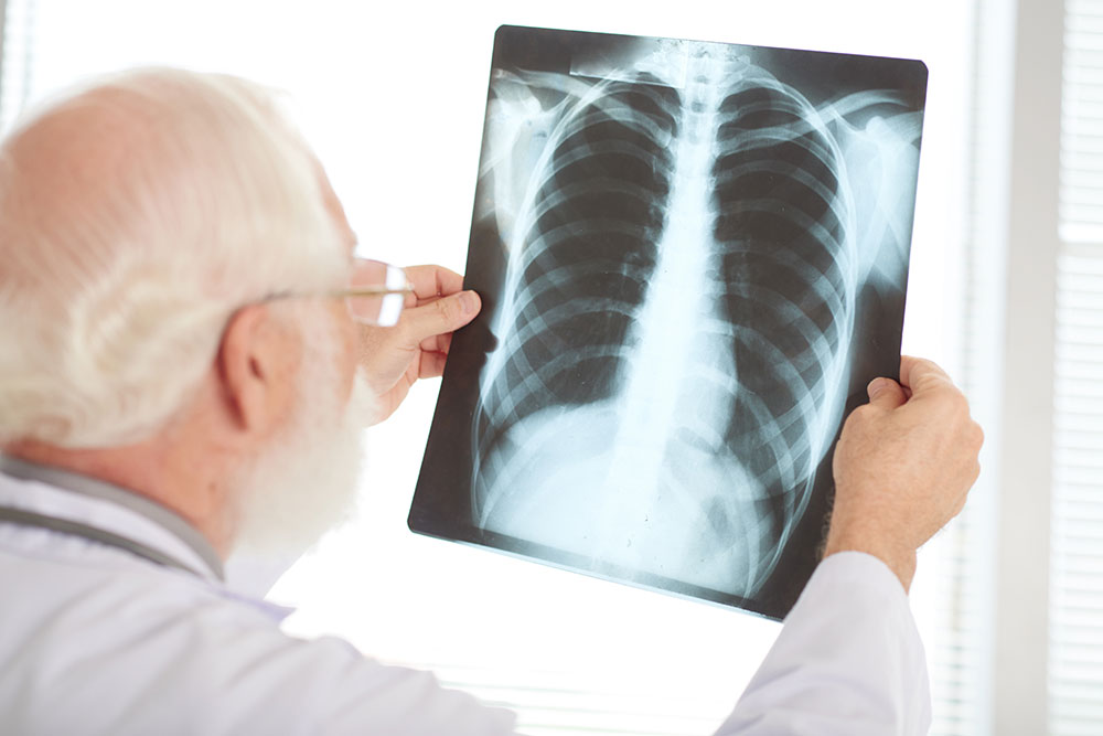 Doctor Checks X-ray for Lung Cancer