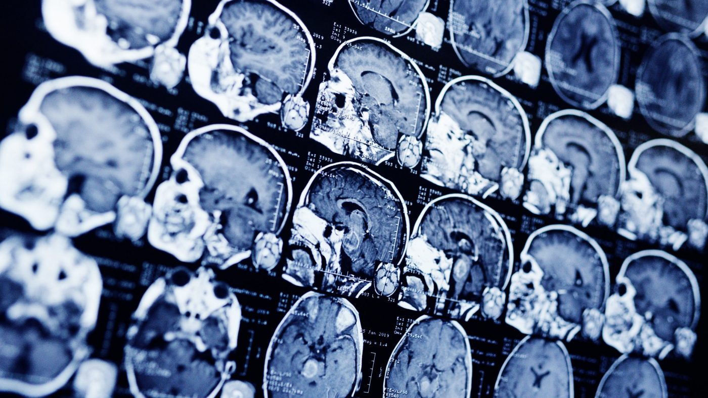 MRI scan of a patient with a tumor in the brain stem. Neurosurgery, cancer, surgery.