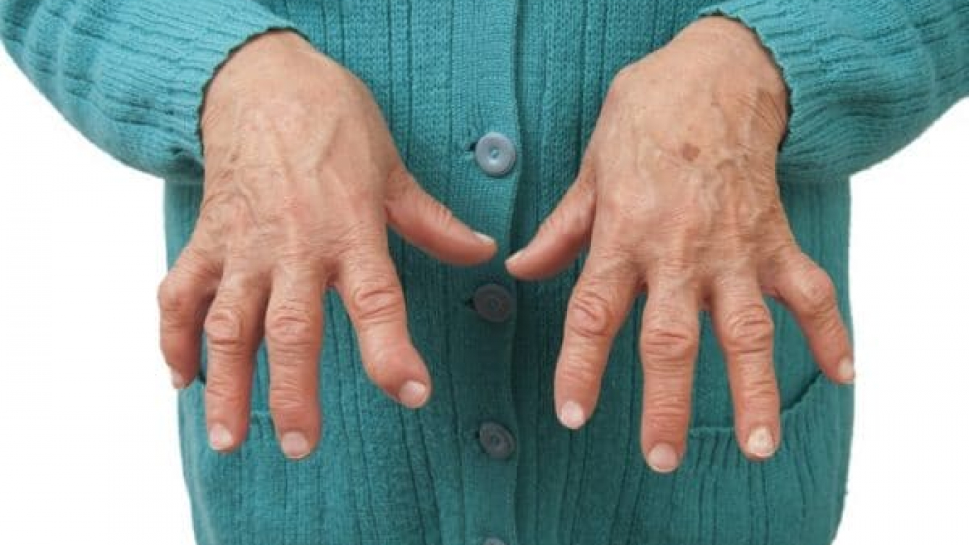 Seropositive-Rheumatoid-Arthritis