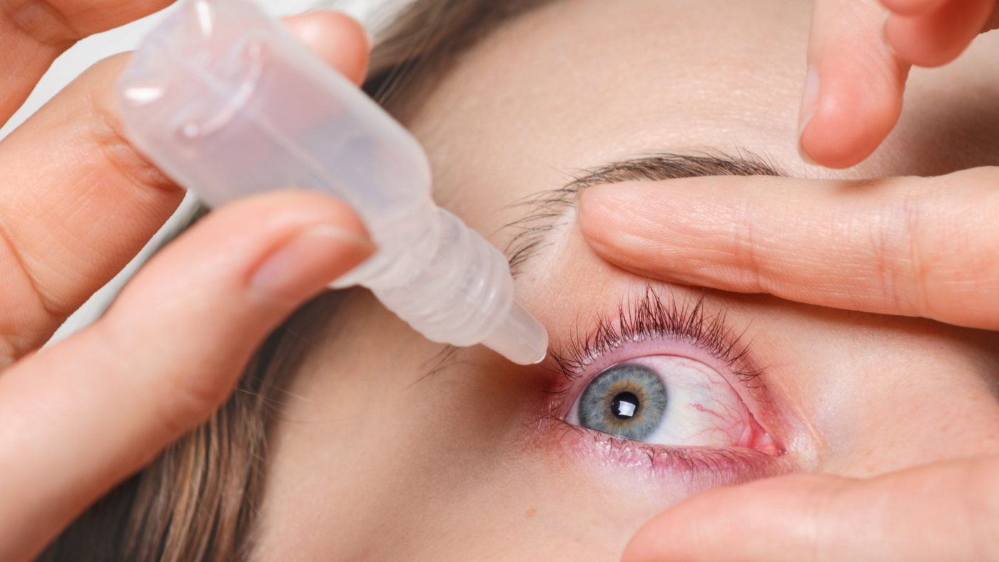 Close up shot of female pours drops in red eye, has conjuctivitis or glaucoma, bad eyesight and pain. Eyes pain treatment concept. Woman cures red blood eye