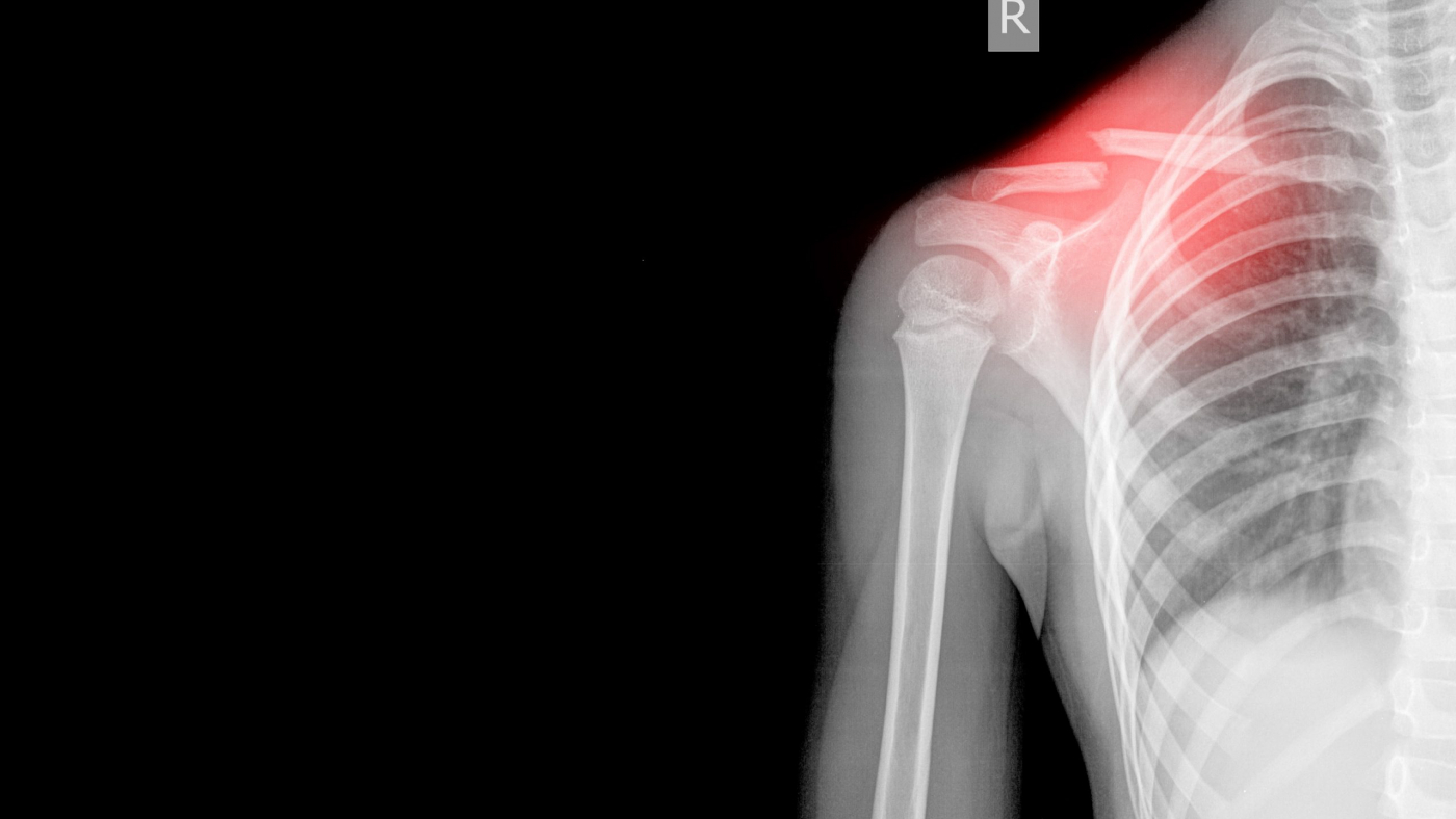 Right Shoulder Xray AP views Showing fracture middle cavicle on red mark,Medical image concept. and coppy space.