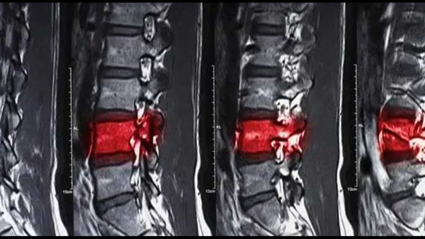 Spinal Cord Injuries Xray Image | New Stem Cell-Based I Tiral