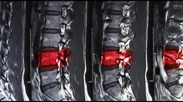 Spinal Cord Injuries Xray Image | New Stem Cell-Based I Tiral