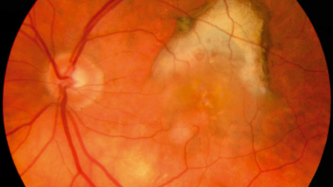 Age-related macular degeneration