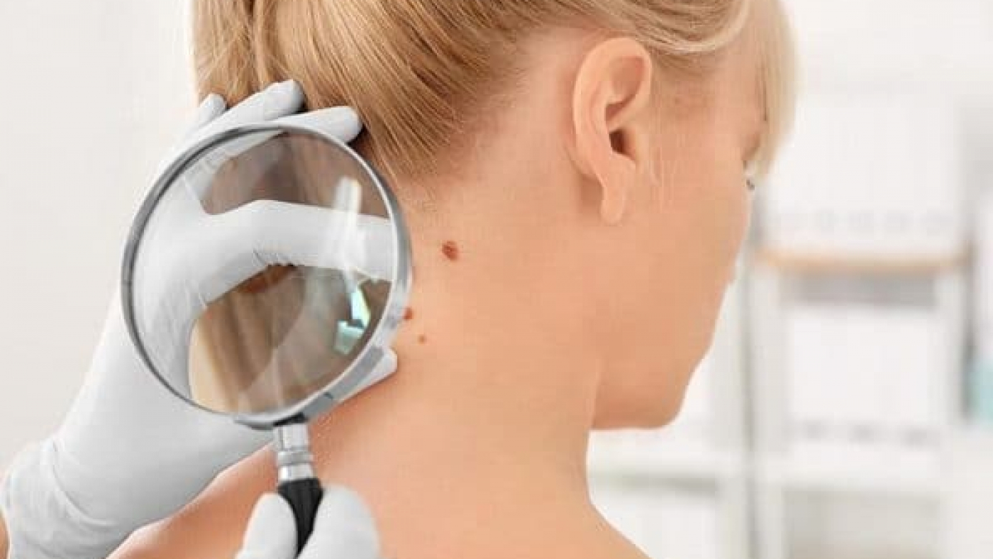 Skin Cancers