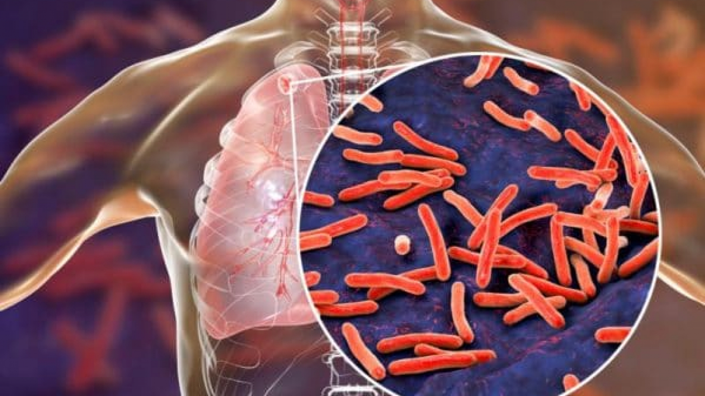 Tuberculosis