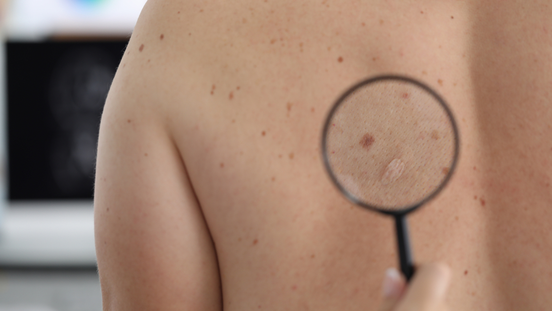 melanoma