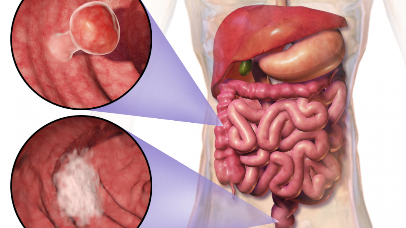 Blausen_0246_ColorectalCancer
